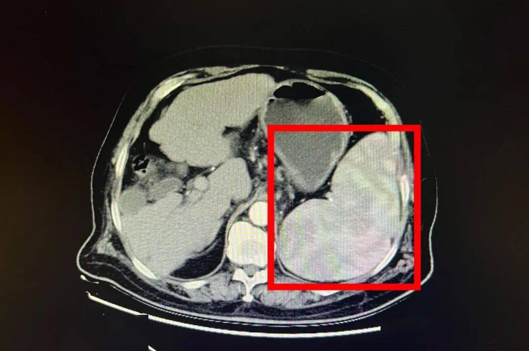 脾肿大是一种常见的医学症状,通常是由于脾脏的体积增大而引起的.