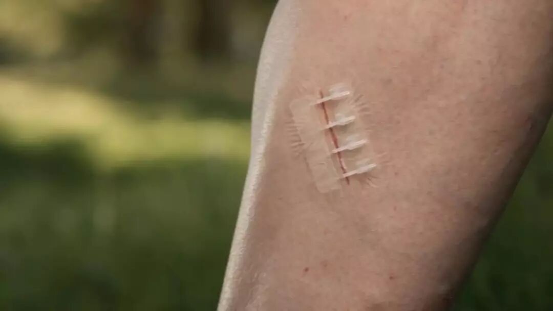减轻伤痛的拉链缝合贴,贴上后静待伤口愈合
