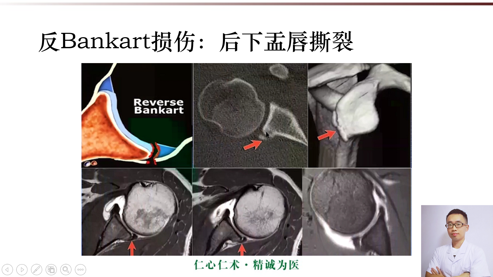 肩关节mri精品课程:肩关节盂唇损伤mri表现!