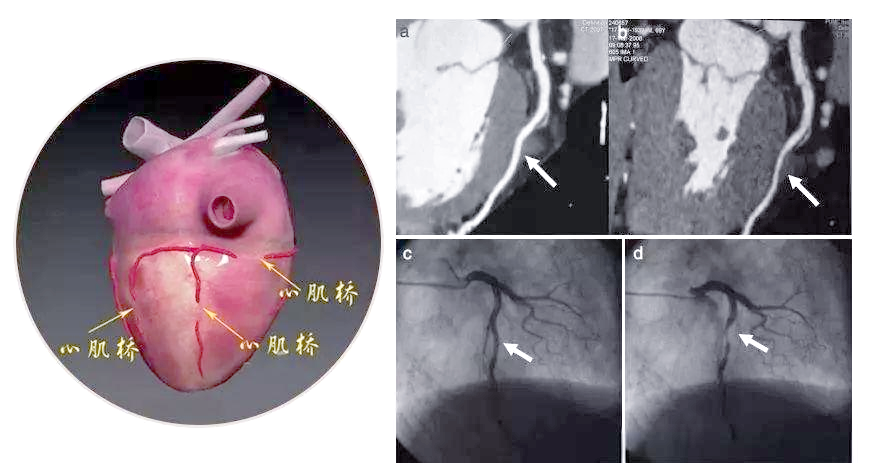 心肌桥,或称心肌桥冠状动脉,是一种较为常见的先天性冠状动脉畸形