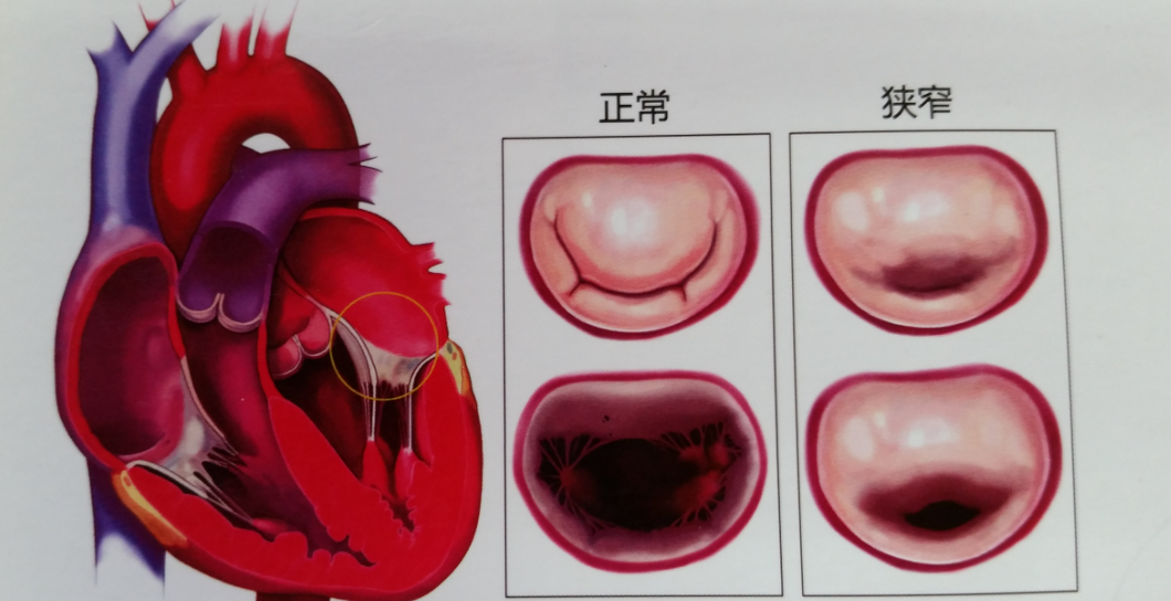心脏瓣膜疾病 baijiahao.baidu.com