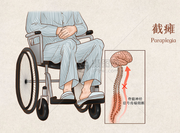 脊髓损伤是什么?典型症状有哪些?