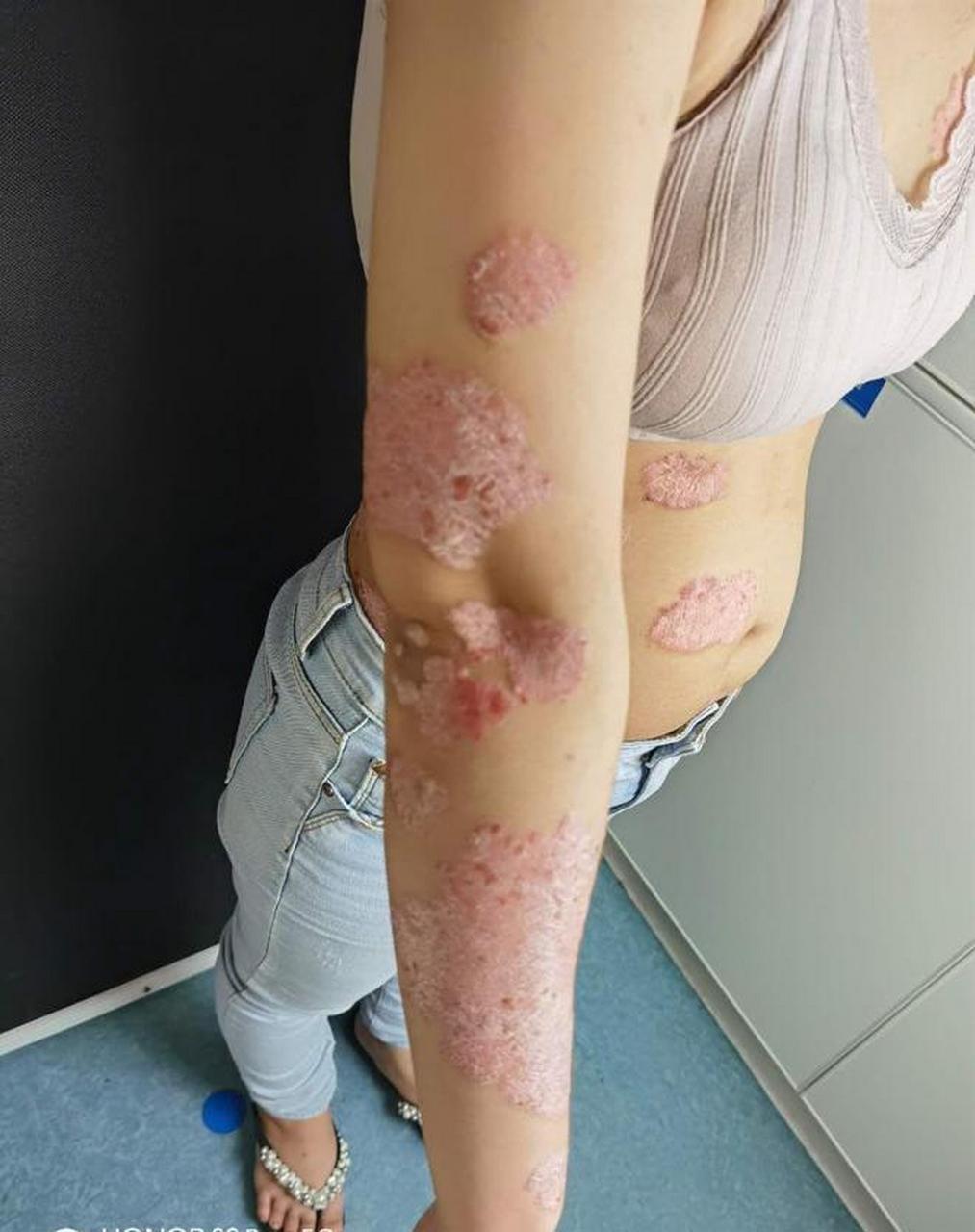 脓疱型银屑病:一般可分为泛发性或掌趾脓疱型银屑病两种.