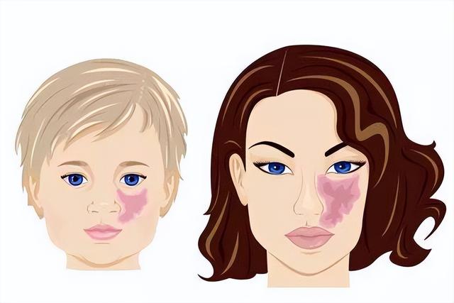 鲜红斑痣怎么治?长治二院"支招"