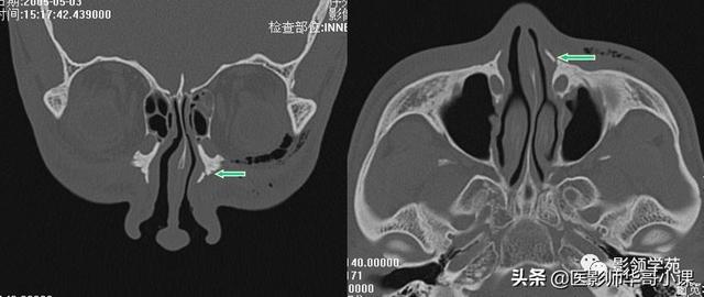 「鼻骨彩图」鼻骨ct解剖及骨折影像学诊断