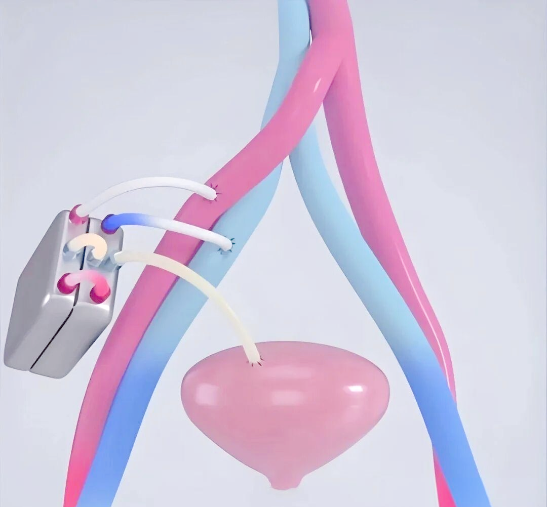 植入式人工肾:开启自由生活的未来