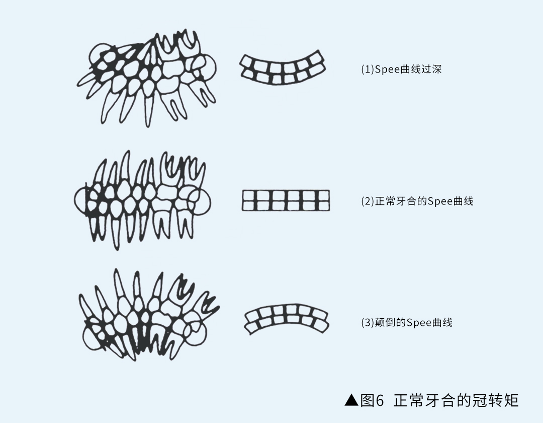 正畸科普 andrews的正常(牙合)六项标准