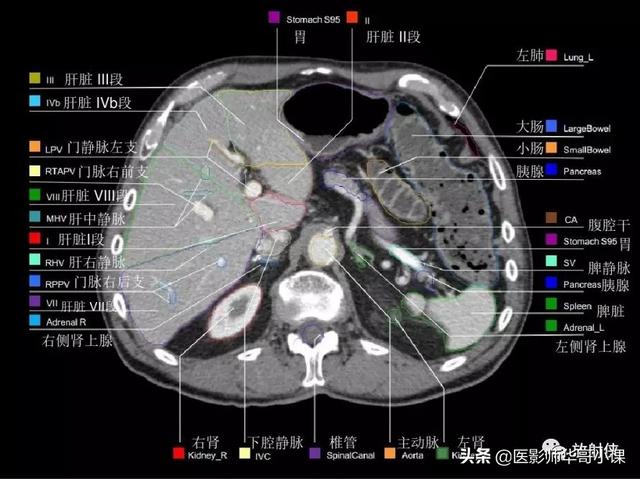 「高清ct图」上腹部及血管ct断层解剖,精品图谱