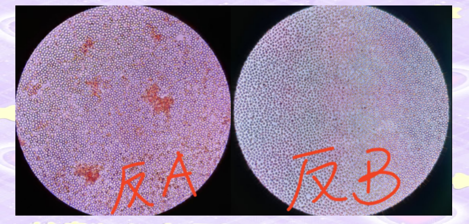 abo血型正反定型不一致案例解析