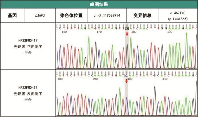 罕见病例以反复肝功能异常为表现的danon病1例
