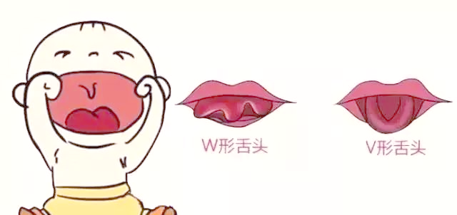 是否需要为孩子进行舌筋矫正手术？家长必知的舌系带知识