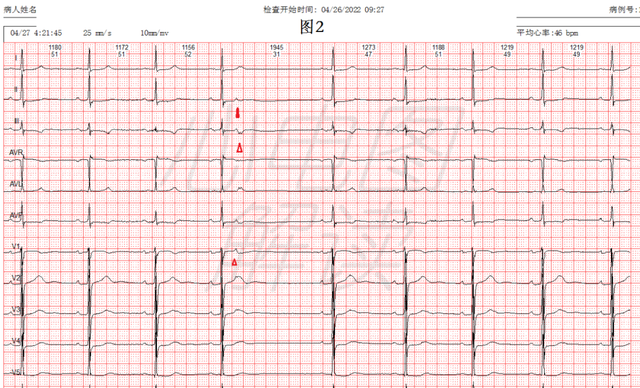 房性早搏未下传图片图片
