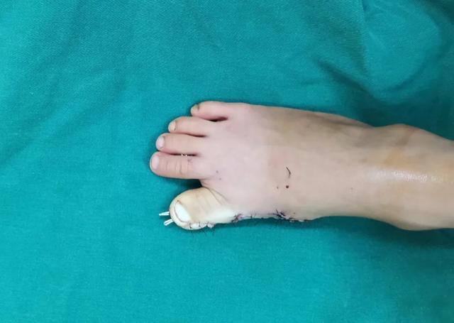 4岁男童天生大脚趾畸形 海南中德骨科医生巧施手术成功矫正