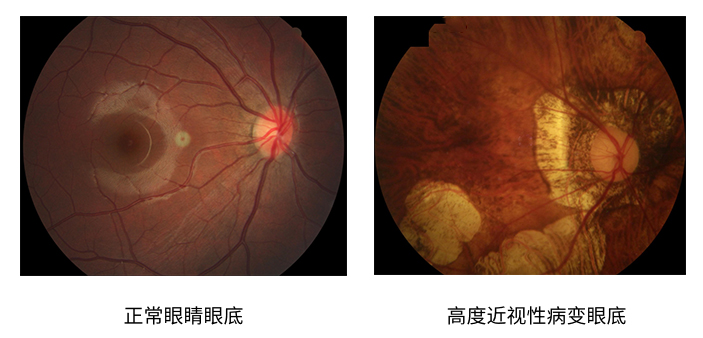 高度近视要警惕眼底病变