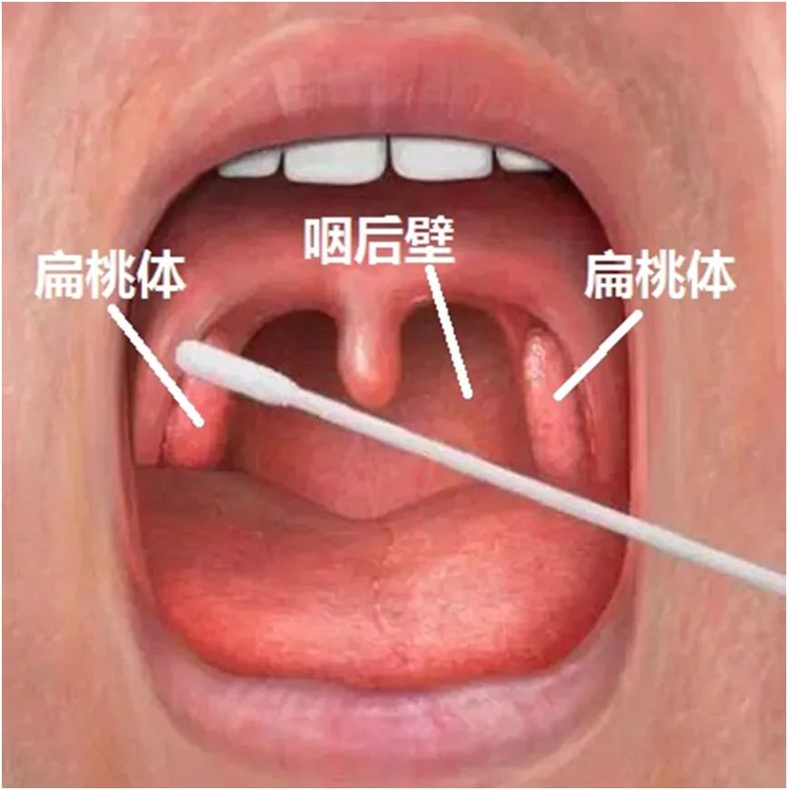 咽部核酸检测部位图片