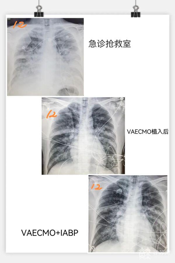 感冒硬扛三天急送icu常州重症医疗团队抢回暴发性心肌炎患者性命