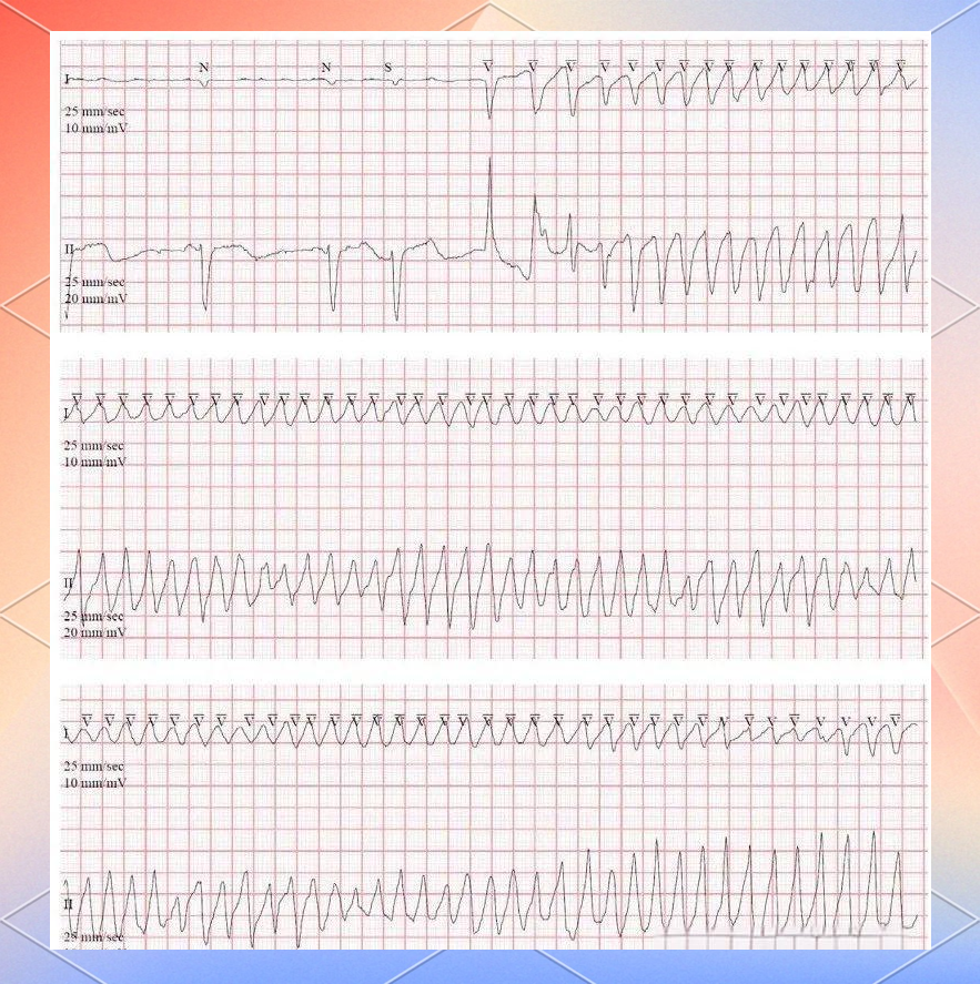 详解:一种与qt延长相关的多形性室速