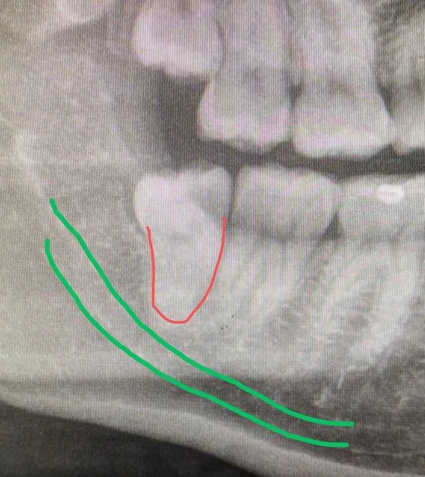 但拔智齿这个过程,会受到各方面因素的干扰,比如 智齿的位置,牙根的