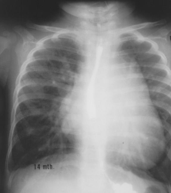 很多人都知道"肺心病",却不知道它发病的具体原因,一起来分析