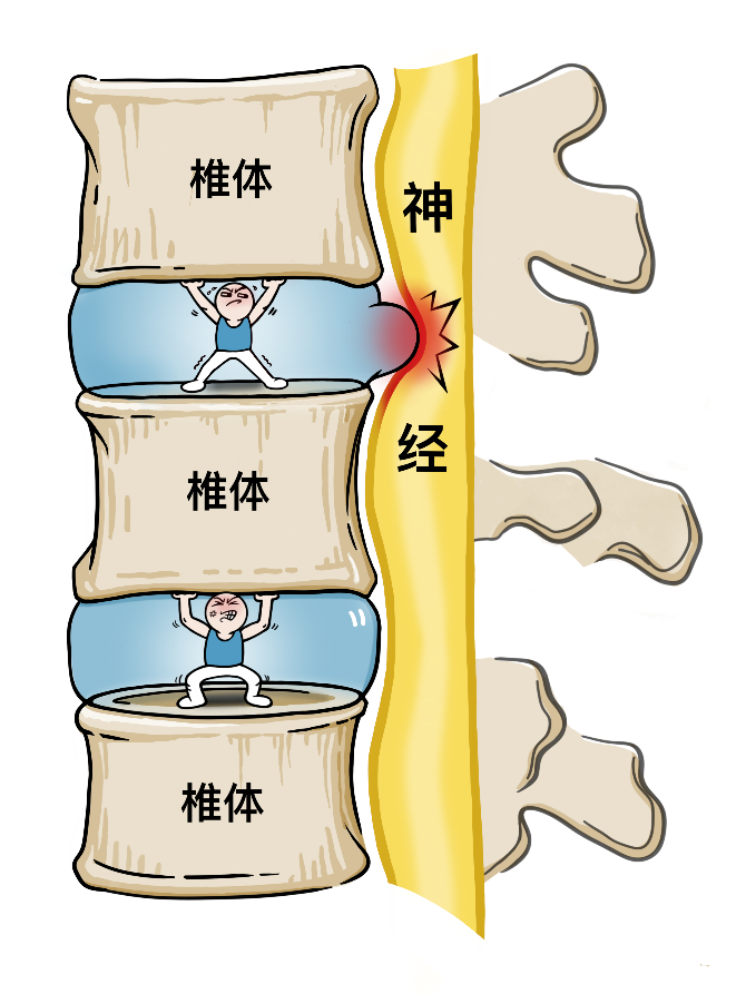 健康科普丨椎间盘突出,你真的了解吗?