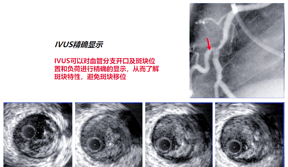 血管内超声(IVUS)技术全面解析,一次了解清楚!