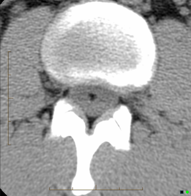 终丝脂肪沉积(fatty filum terminale)