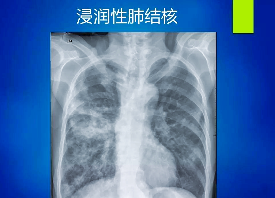 众多典型胸片,助你提升临床观察能力