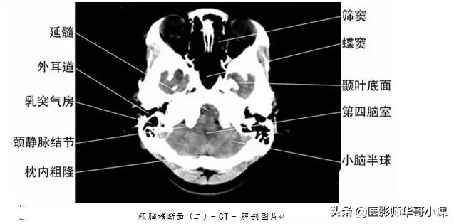 「高清ct图」头颅,胸部和腹部ct解剖图谱