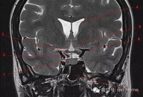 垂体柄解剖图磁共振图片