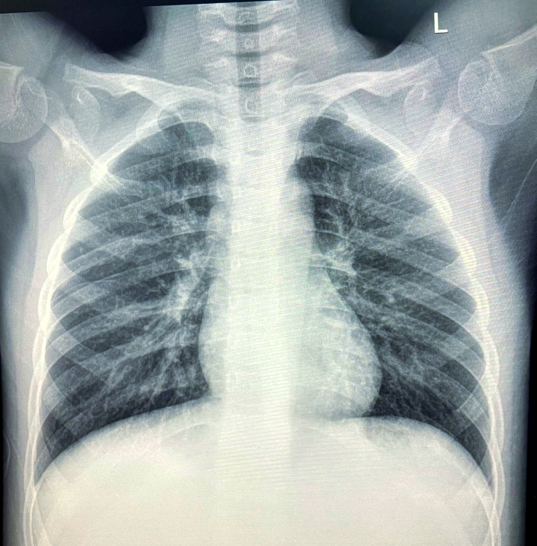 「健康科普指南」如何拍摄高质量的胸片?