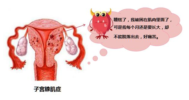 腺肌症图片