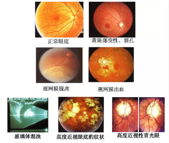 警惕高度近视带来的眼底病变