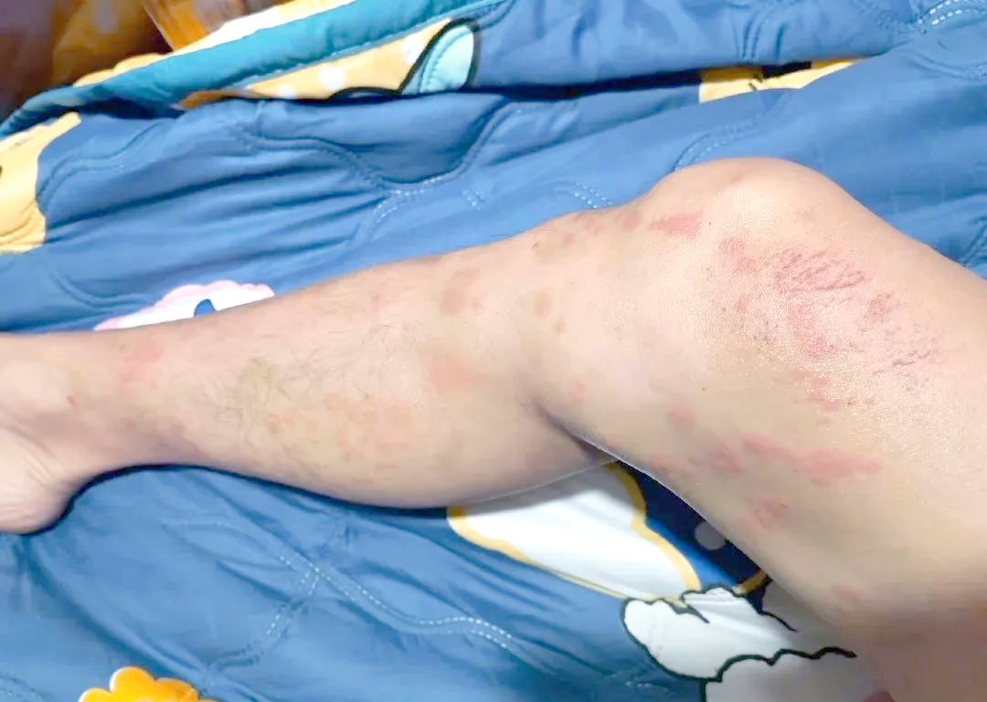 海滩游玩需警惕:这种"塑料袋"水母有毒,触碰后可能引发剧烈灼烧感