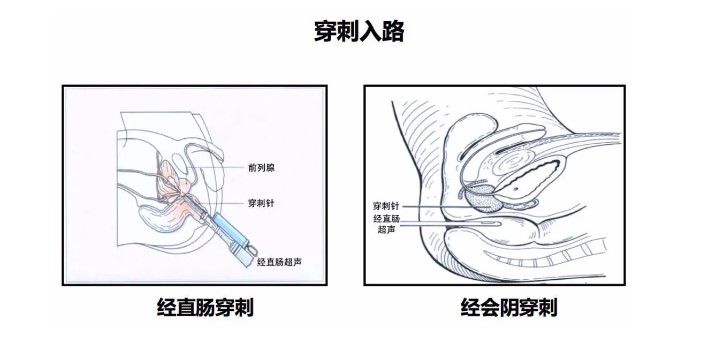 潍坊市人民医院泌尿外科三区开展该院首例超声引导下经会阴前列腺穿刺