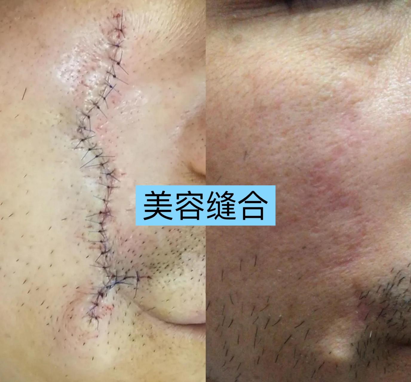 普通缝合后的疤痕情况美容缝合后的疤痕情况:  小针细线≠美容缝合