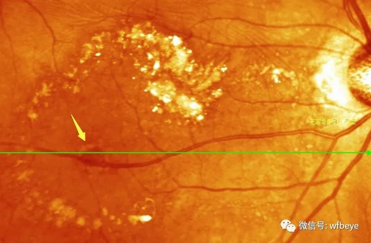 视网膜大动脉瘤(1):几个临床概念性问题