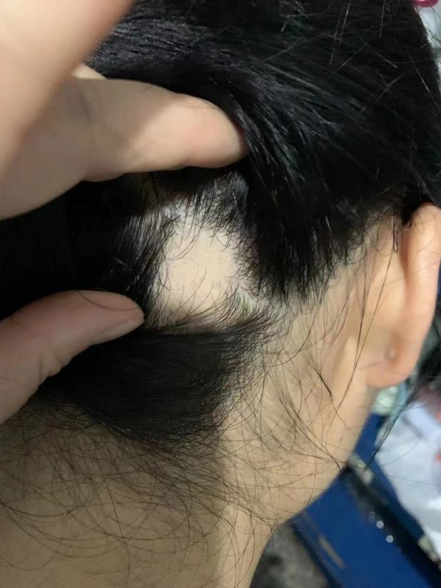 20岁女孩遭遇"鬼剃头"!