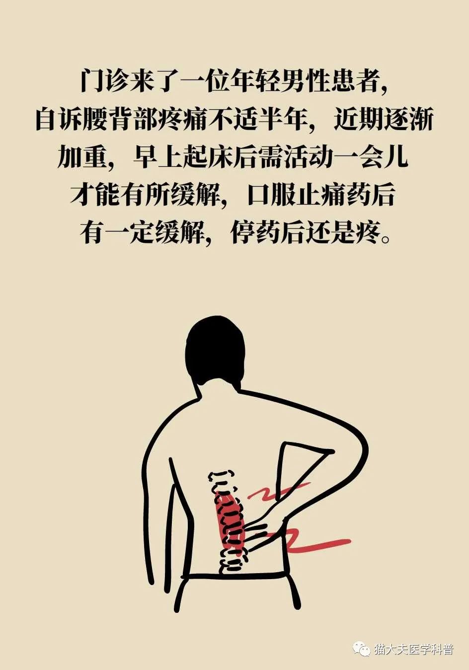 强直性脊柱炎正盯上年轻人,这种"不死的癌症"是否能治好?