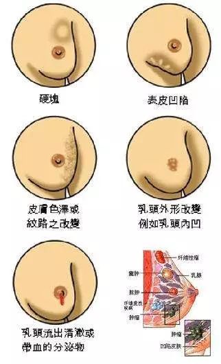 乳房橘皮纹是什么样的图片