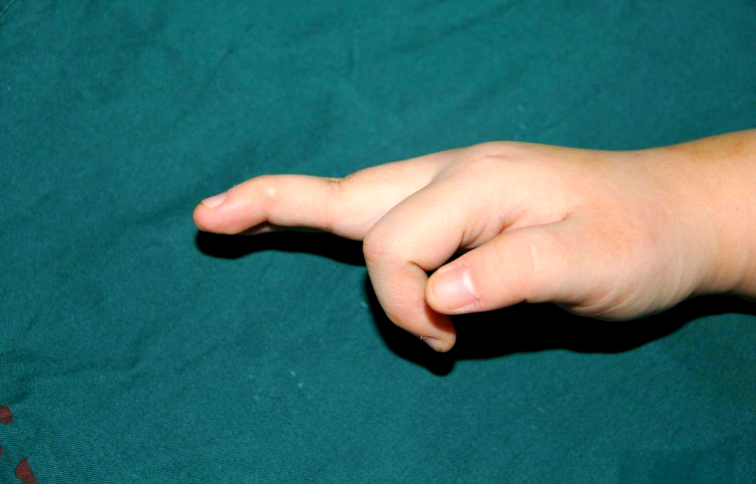 手指天鹅颈畸形:类风湿关节炎等导致的常见原因