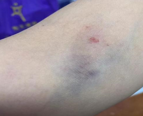 抽血后淤青,鼓包,该谁背锅?