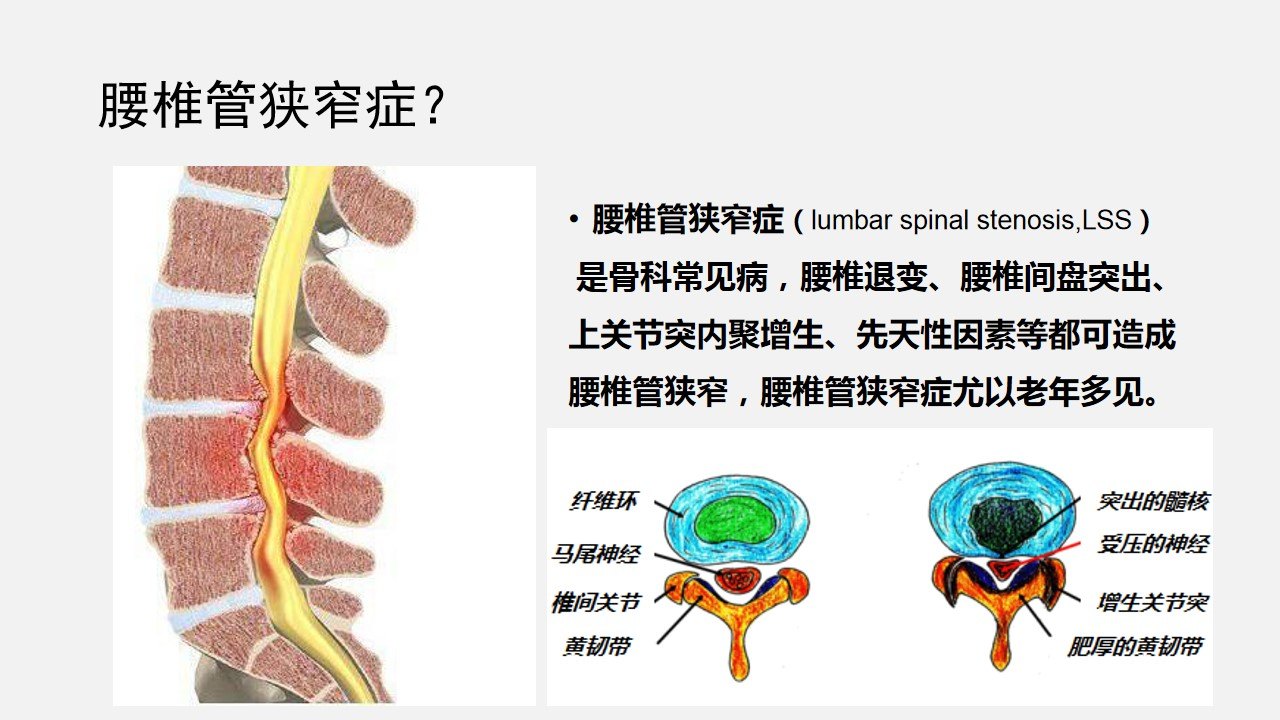 椎管狭窄是怎么造成的图片