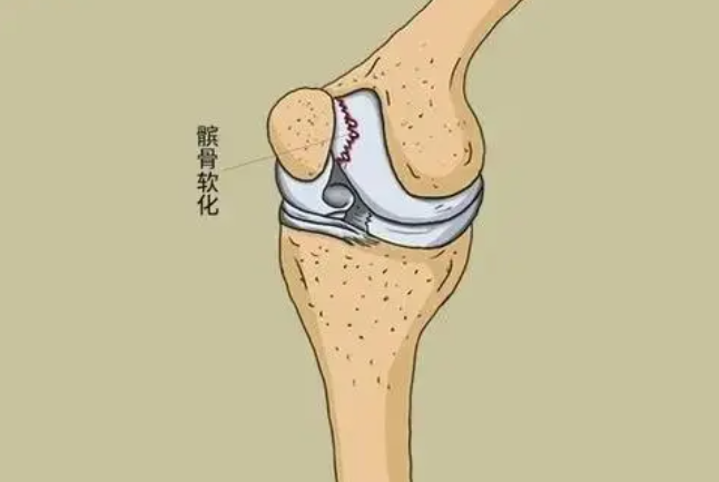 走路时,膝盖突然"软"一下,是咋回事?要警惕这几种情况