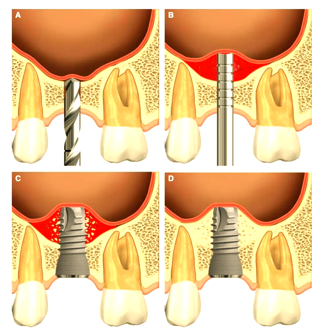 植骨:确保种植牙成功的基石