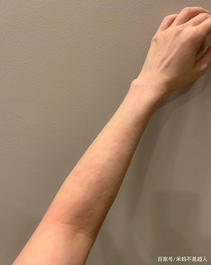 身体乳可以擦红疹吗（擦了过期的身体乳身上起红疹子）