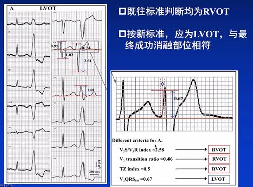 方丕华:室性心律失常起源点鉴别新方法|occ 2021