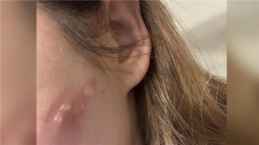 女生玩手机睡着：iPhone贴在脸上直接烫出4颗大水泡！