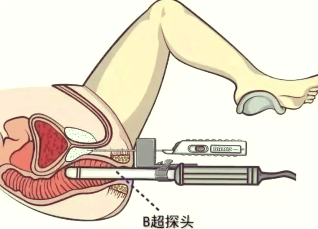 伊宁县医疗突破:潘永昇成功开展前列腺穿刺术