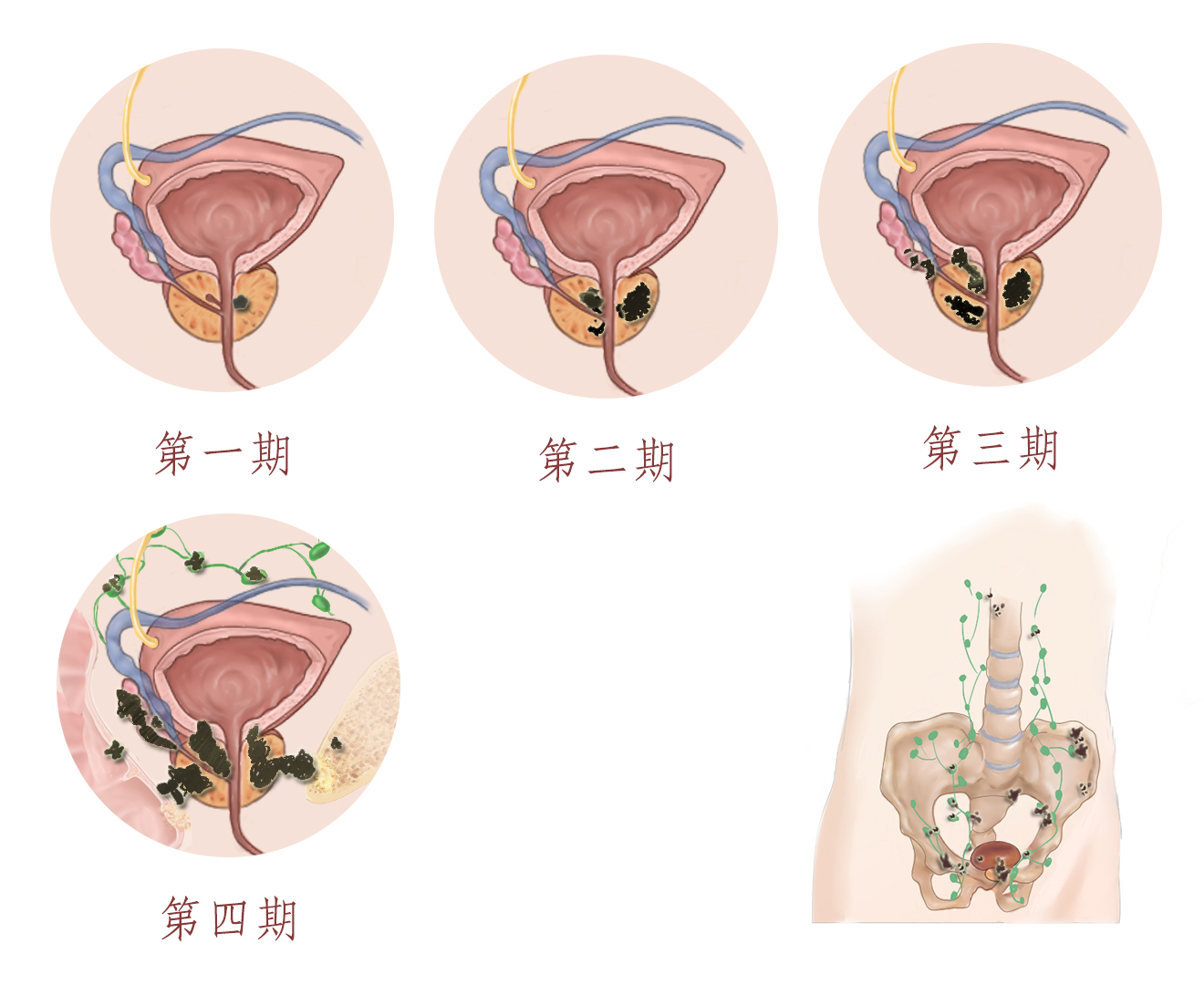 前列腺癌位置图图片