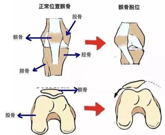 髌底与髌尖位置图片图片